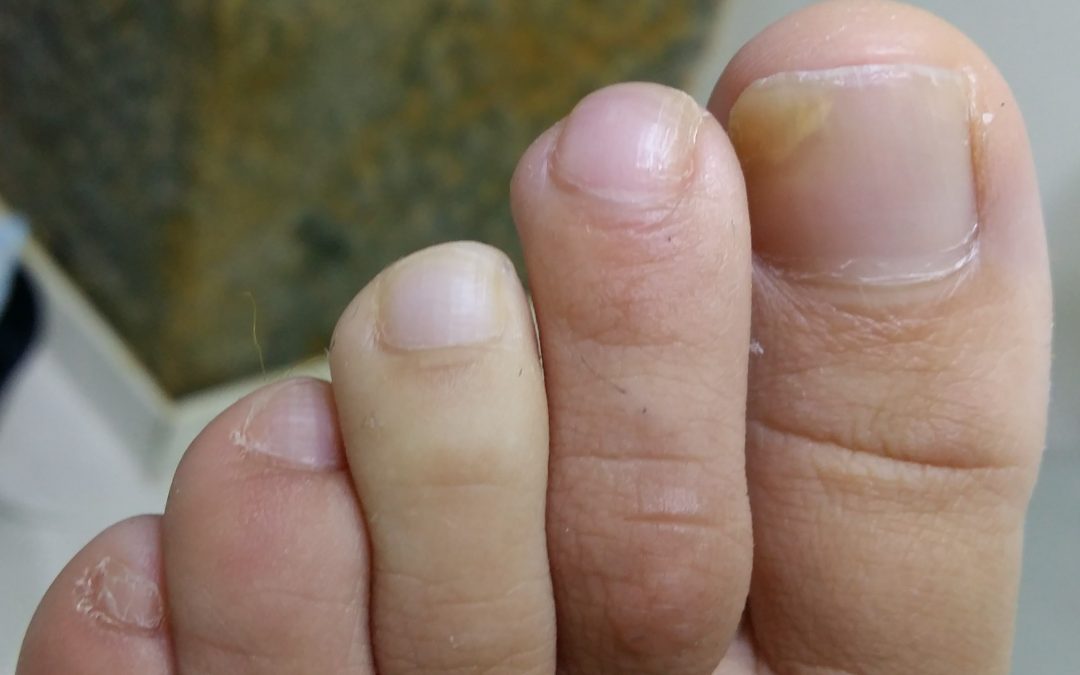 Patologías más comunes en los pies después del verano